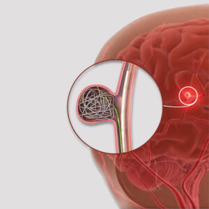 Spider DETECHABLE NEURO EMBOLIZATION COIL
