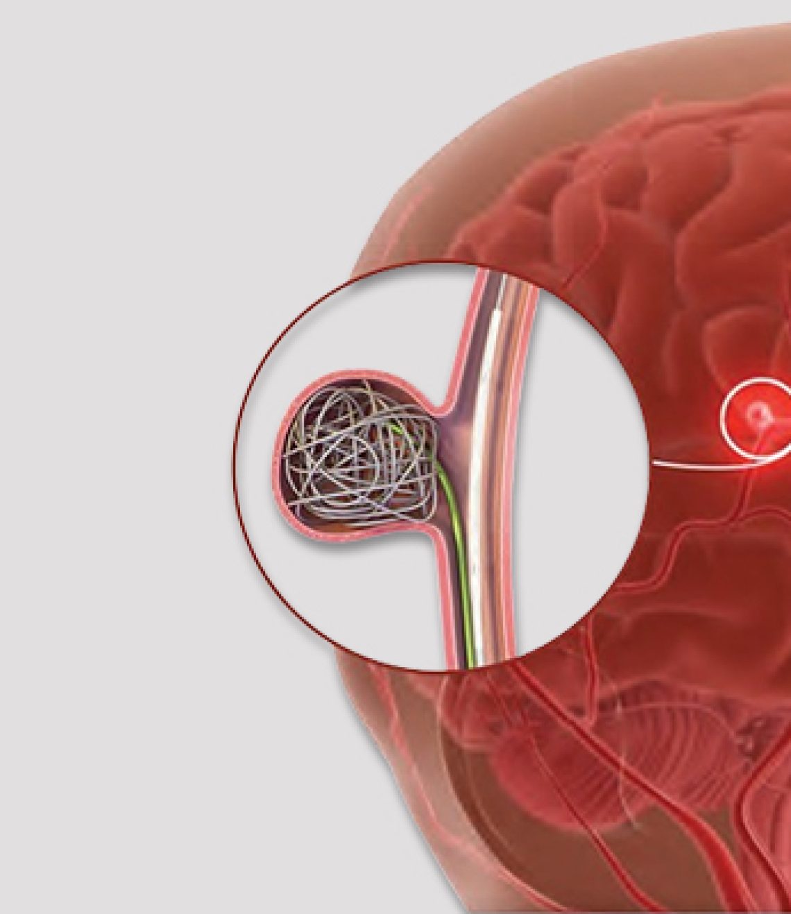 Spider-DETECHABLE-NEURO-EMBOLIZATION-COIL